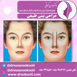 جراحی-طبیعی-بینی