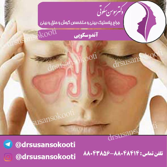آندوسکوپی