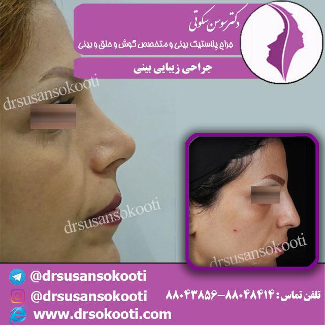 چگونگی انجام عمل زیبایی بینی برای افراد ورزشکار