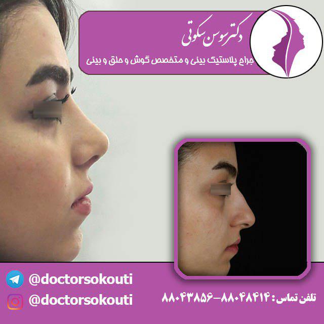 جراحی بینی استخوانی