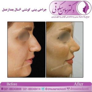 جراحی ترمیمی بینی