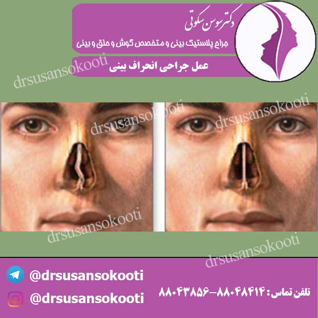 عمل جراحی انحراف بینی