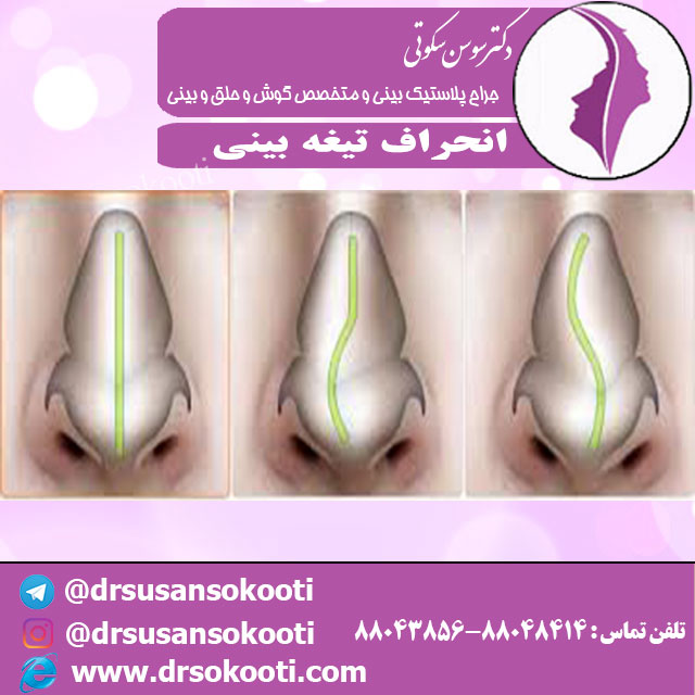 انحراف تیغه بینی