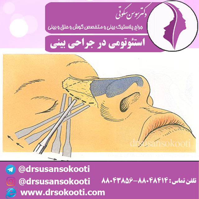 استئوتومی در جراحی بینی