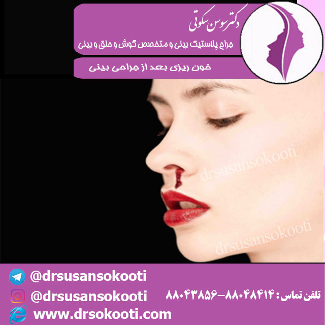 خون ریزی بعد از جراحی بینی