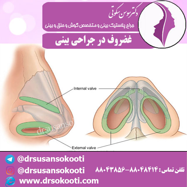 کاربرد غضروف در جراحی بینی