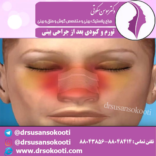 تورم و کبودی بعد از جراحی بینی