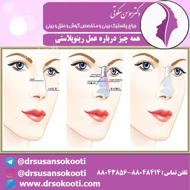 همه چیز درباره عمل رینوپلاستی