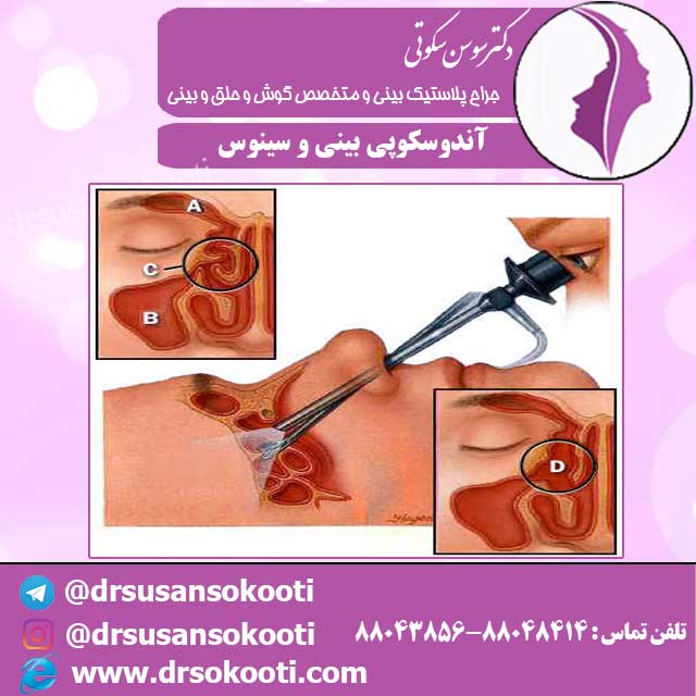 آندوسکوپی بینی و سینوس