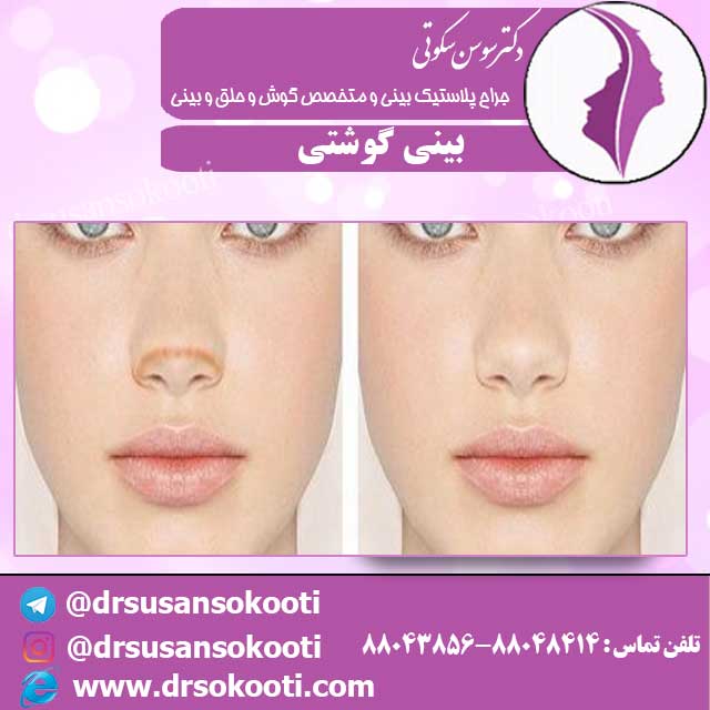 معرفی بینی گوشتی