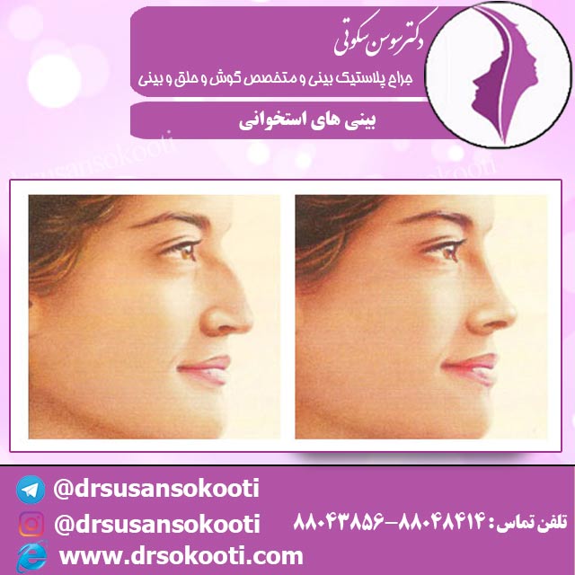 بینی های استخوانی