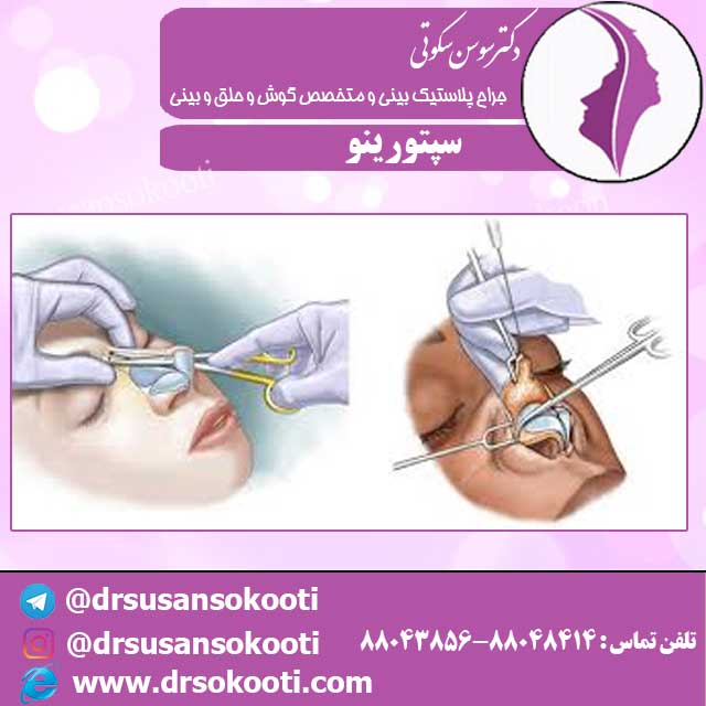 سپتورینو