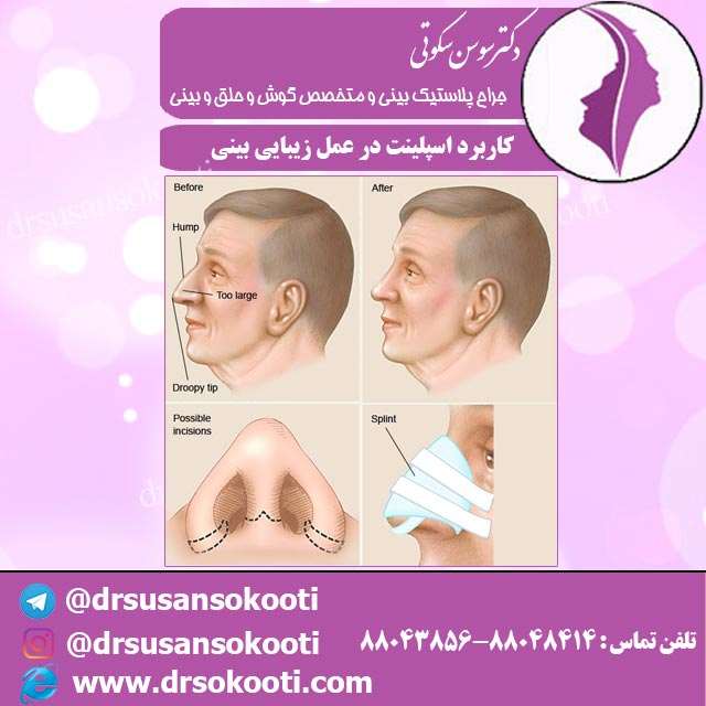 کاربرد اسپلینت در عمل زیبایی بینی