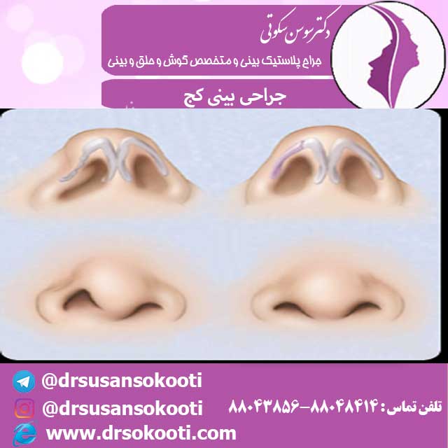 جراحی بینی های کج