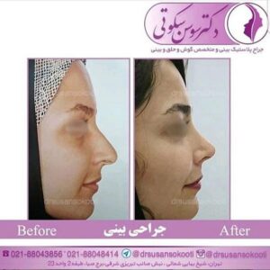 عمل بینی استخوانی
