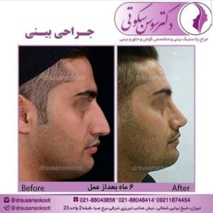 عمل بینی استخوانی