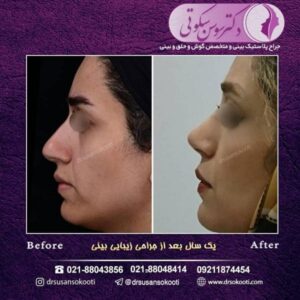تفاوت جراحی بینی استخوانی و گوشتی