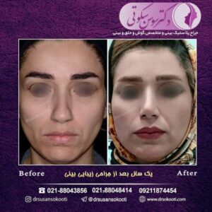 تفاوت جراحی بینی استخوانی و گوشتی