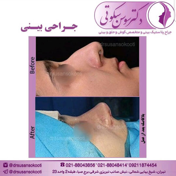 جراحی کوچک کردن بینی