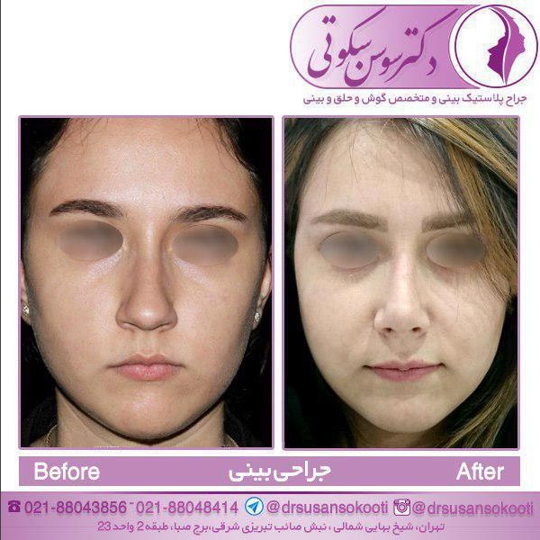 جراحی زیبایی بینی در تهران