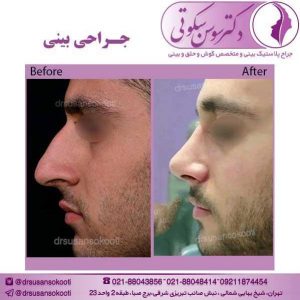 بهترین جراح بینی استخوانی در تهران