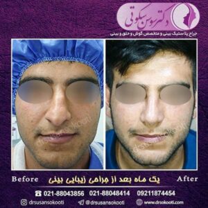 جراحی زیبایی بینی
