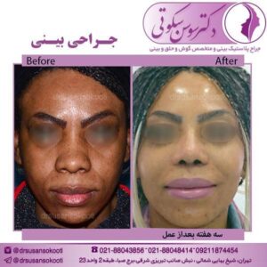 جراحی بینی پهن