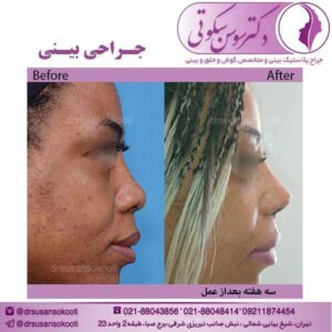 جراحی بینی پهن