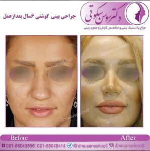 جراحی بینی پهن