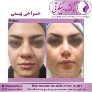 جراحی بینی پهن