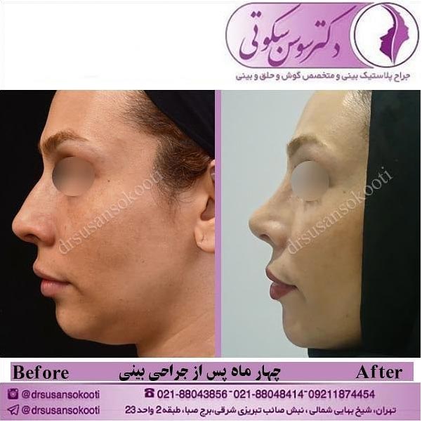 عمل جراحی بینی استخوانی
