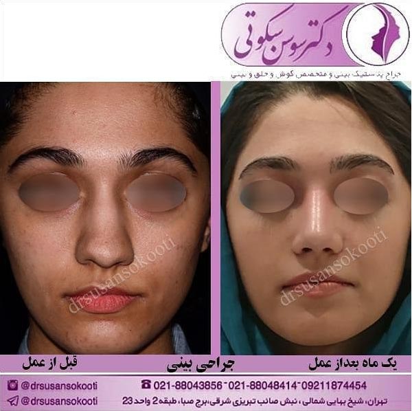 عمل جراحی بینی گوشتی