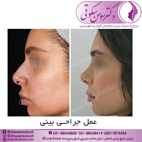 عمل جراحی بینی