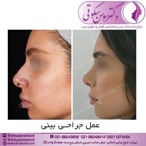 عمل جراحی بینی