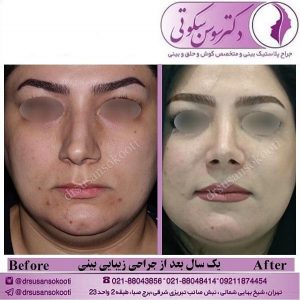 قبل و بعد از جراحی زیبایی بینی
