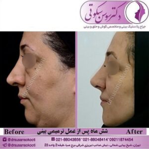 عمل ترمیمی بینی