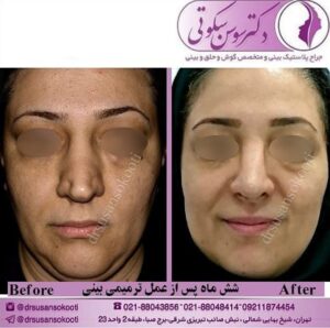 عمل ترمیمی بینی