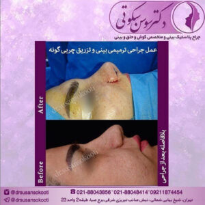 عمل ترمیمی بینی