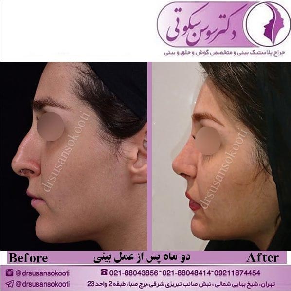 جراحی زیبایی بینی تهران