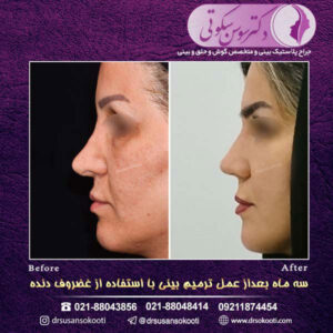 جراحی بینی ثانویه