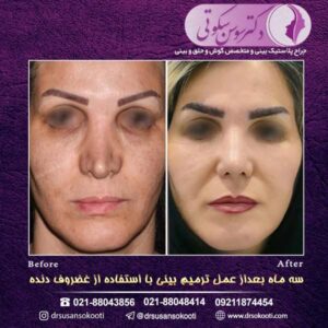 جراحی بینی ثانویه