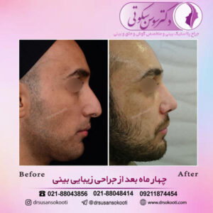 انحراف تیغه بینی