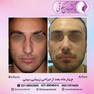 انحراف تیغه بینی