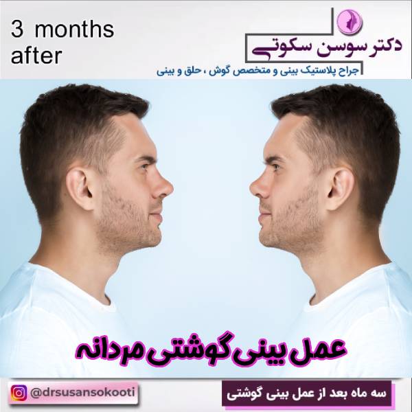 عمل جراحی بینی گوشتی مردانه - دکتر سوسن سکوتی