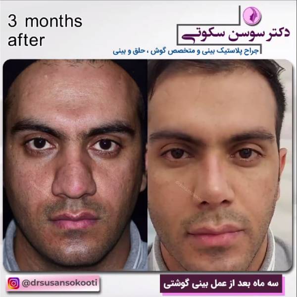 عمل قبل و بعد عمل بینی گوشتی مردانه - دکتر سوسن سکوتی