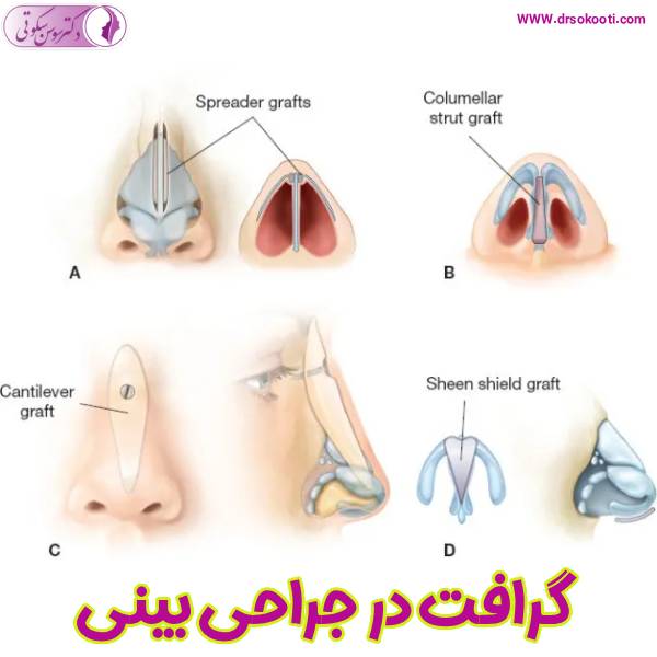 گرافت گذاری در جراحی بینی - دکتر سوسن سکوتی