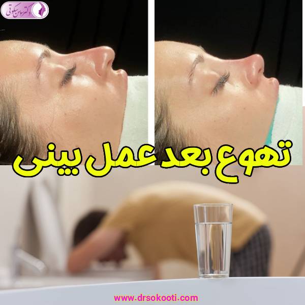 تهوع بعد عمل بینی - دکتر سوسن سکوتی
