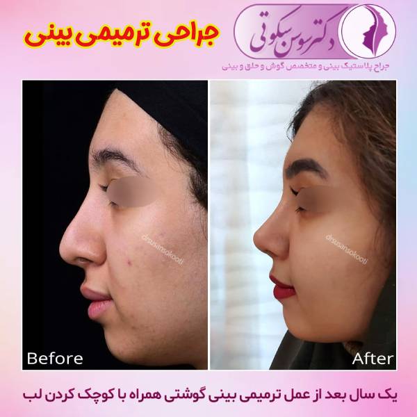 جراحی ترمیمی بینی - دکتر سوسن سکوتی
