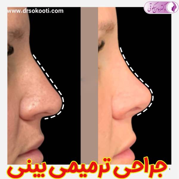 جراحی ترمیمی بینی - دکتر سوسن سکوتی