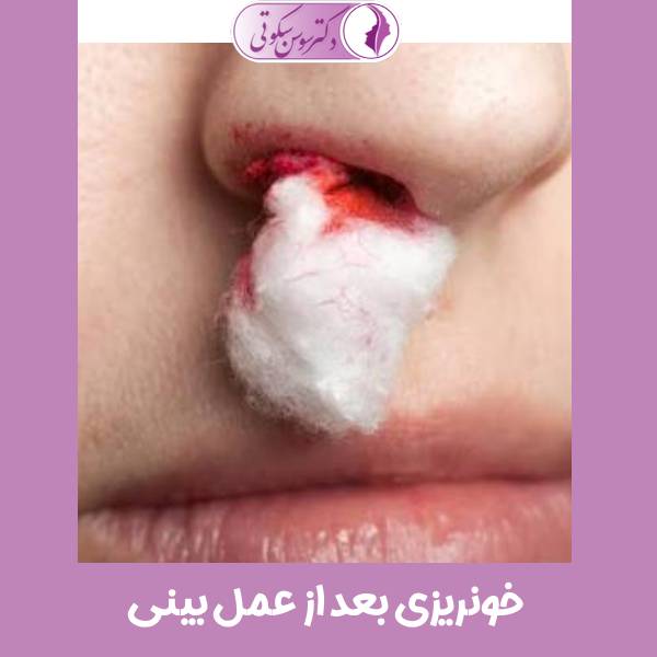 خونریزی بعد از عمل بینی